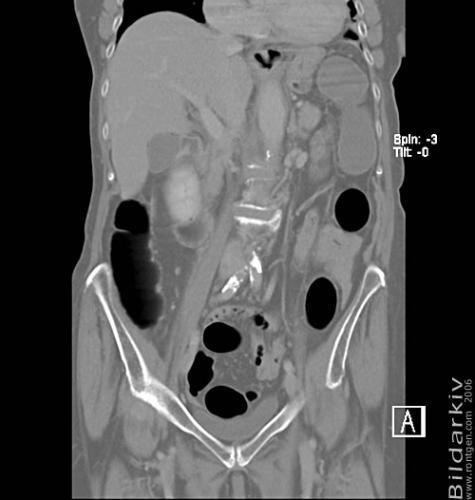 CT colon 27